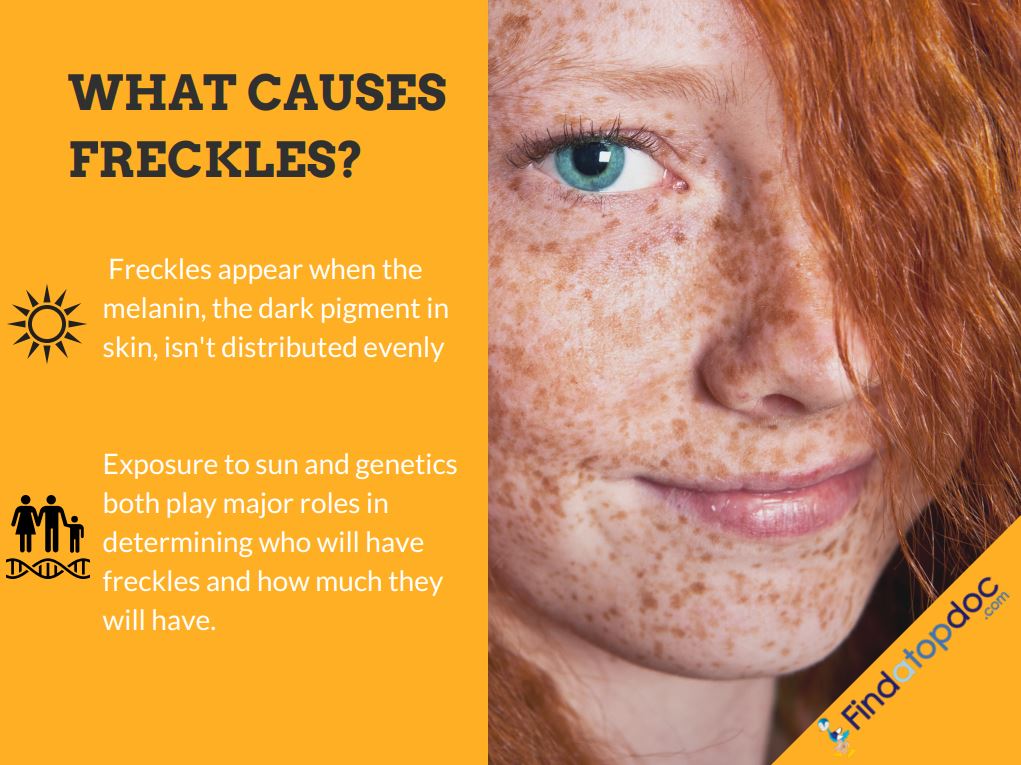 #Health #Fitness #HealthyLiving #Freckles